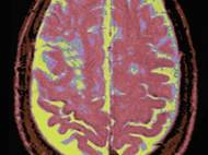 Brain activity recorded by a MRI