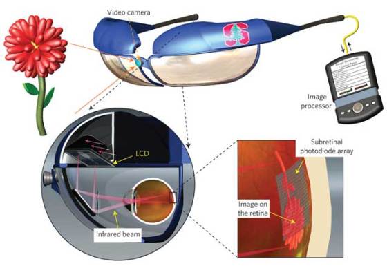 nphoton-stanford-retinal-prosthesis