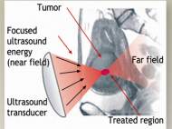 high-intensity-focused-ultrasound-illustration